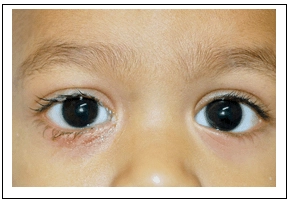 Eye Health Of Children