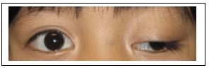 What is Double Vision (Diplopia)?
