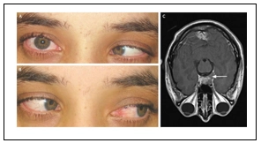 What is Double Vision (Diplopia)?