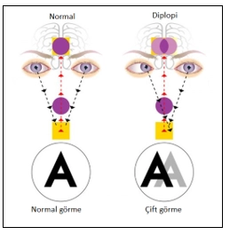 What is Double Vision (Diplopia)?