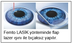 Excimer Laser Chirurgie