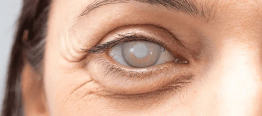 What happens if you have cataracts in your eye?